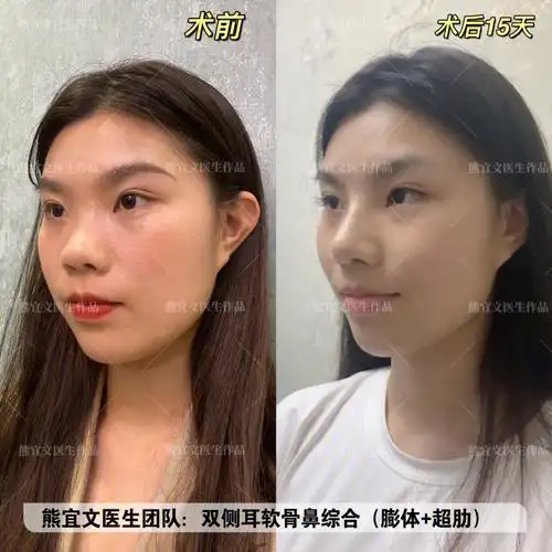 耳软骨超肋术后15天朝天鼻的逆袭