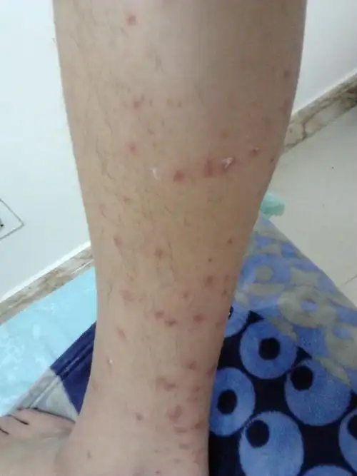 问:大家能帮我看看这是被蚊虫叮咬的还是过敏吗?