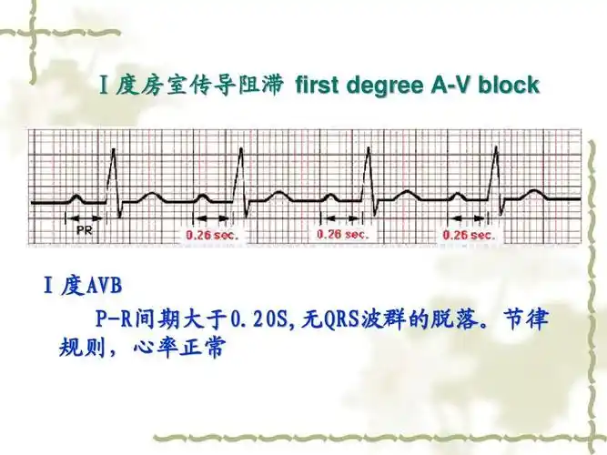 Ⅰ度房室传导阻滞 first degree a-v block Ⅰ度avb p-r间期大于0.