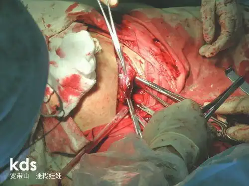 顺产破腹产全过程,男人们请珍惜为你生孩子的那个女人