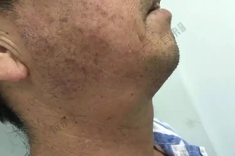 颈前下倾处颌下腺肿胀图