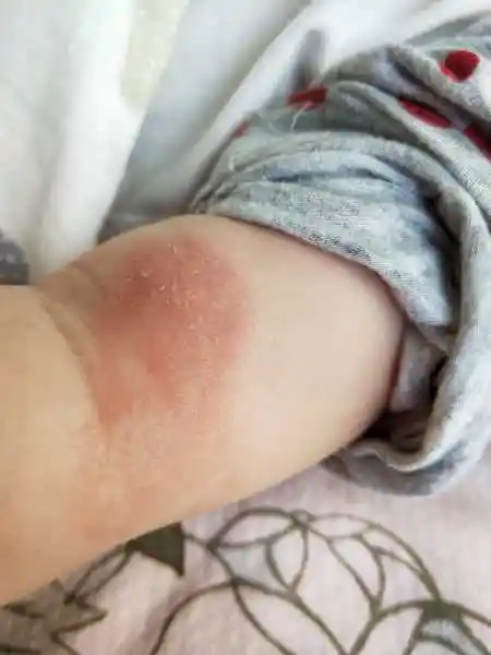 是女宝宝,他的手上有这种图片上的情况,请问一下是湿疹还是癣?