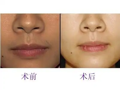 脱唇毛对比
