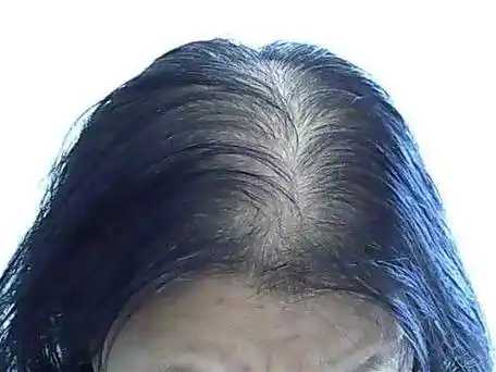 女性常见的脱发有哪几种?如何提前做到预防?滋森漫为您剖析