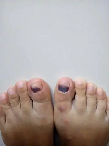 脚指甲黑色素瘤早期症状