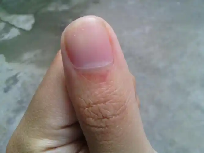 双手大拇指指甲跟后面出现紫色,没有碰到,或者挤压到,这是什么情况