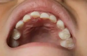 多生牙门牙的修复办法?