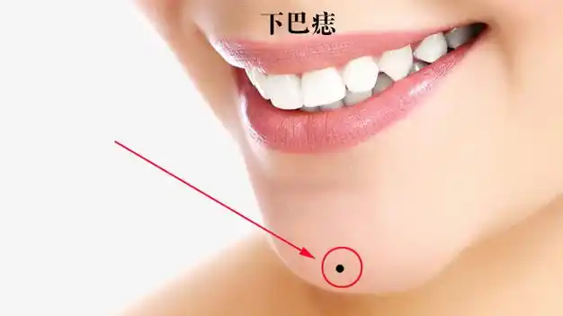 下巴痣