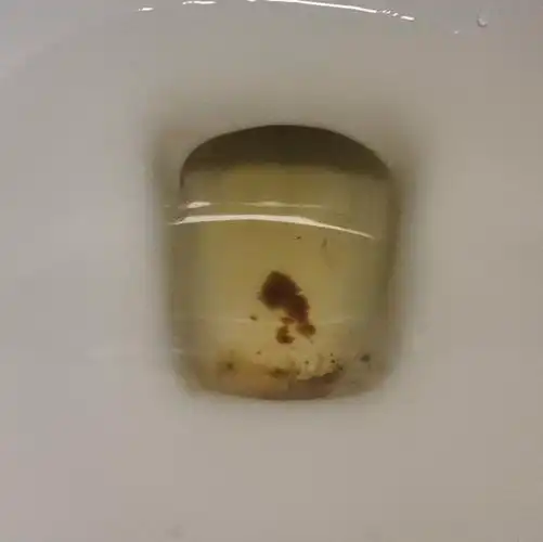 药流有大残留2.2cm,历时72天未清宫,干净了!(带图) 给姐妹们定个心!