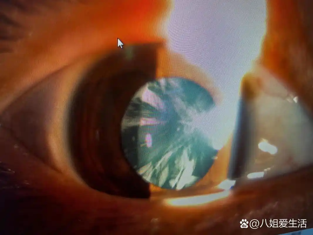 30岁左右白内障一例 照片分别为右眼和左眼的前节照相,可见晶状体较为