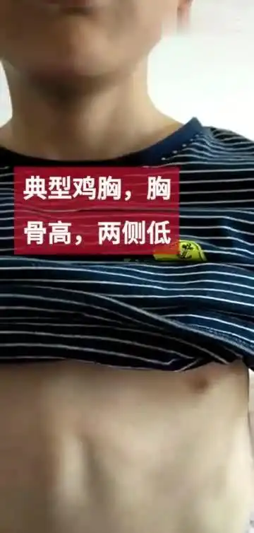 小孩子鸡胸可以改善吗?-健康视频-搜狐视频