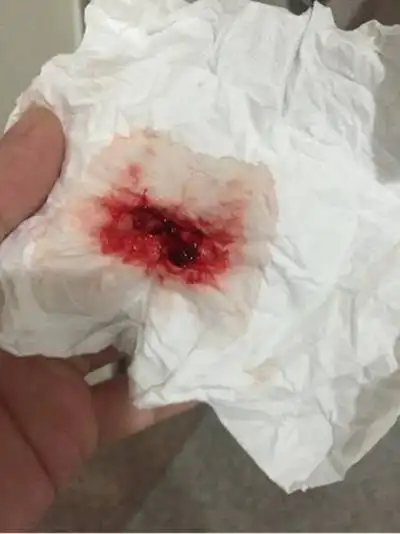 胃出血图片_胃出血症状表现图片大全_有来医生