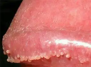 阴茎珍珠状丘疹