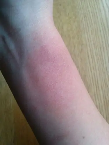 手腕处不知道什么时候红了一块区域 不痛不痒 也没有凸起 有时候颜色