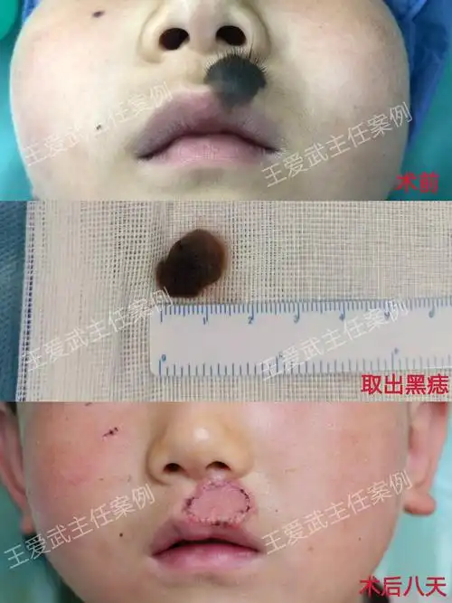 黑痣切除 - 好大夫在线