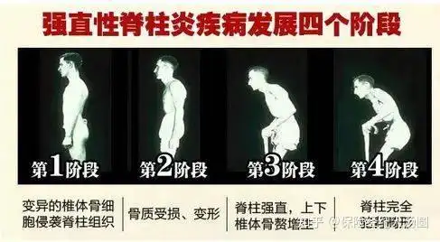 重疾险问题强直性脊柱炎患者是否符合条件