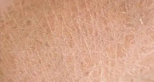 你有毛周角化症吗?