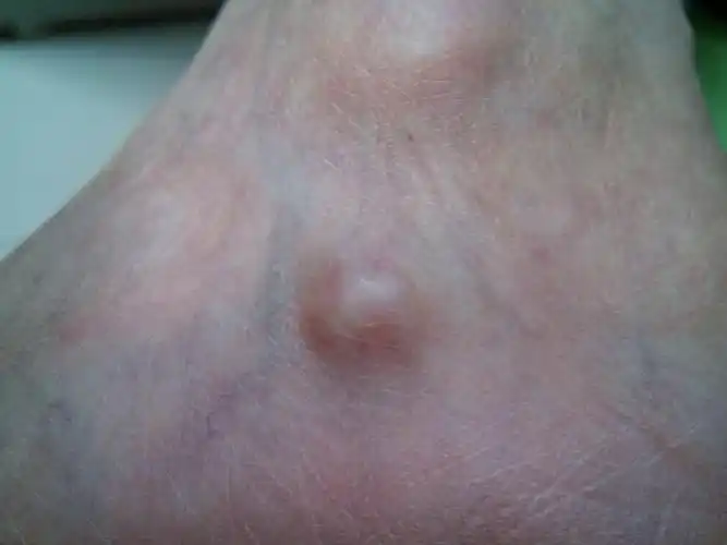 女友左脚踝外侧以下长了一个肉疙瘩(如图