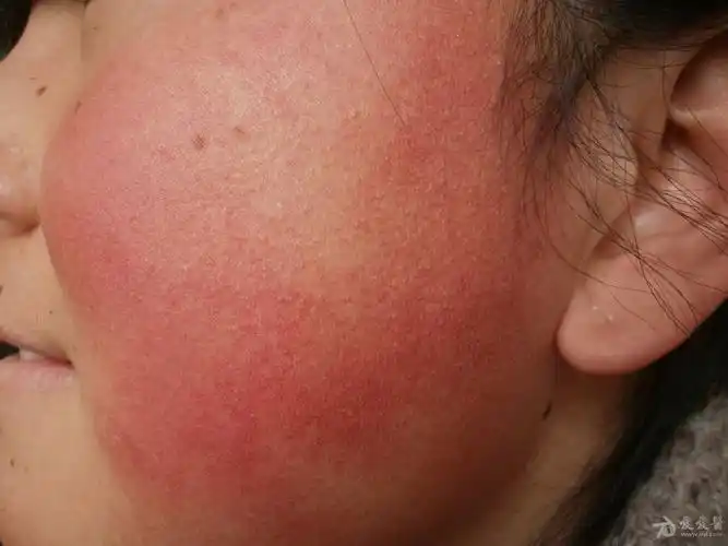 病例分享:面颈部毛囊红斑黑变病.