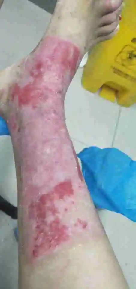 煤气烧伤,这是被误诊的三度烧伤么