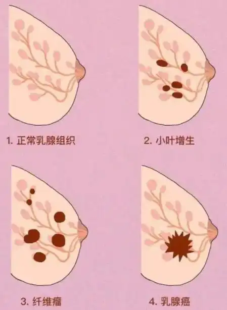 国内乳腺癌好的医院