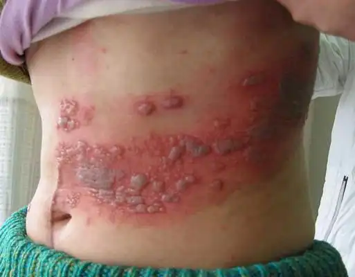 疱疹图片大全 (7)