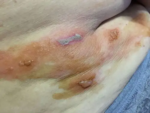 奶奶胸部以下长了这样的疙瘩,连续的小泡是刚开始长