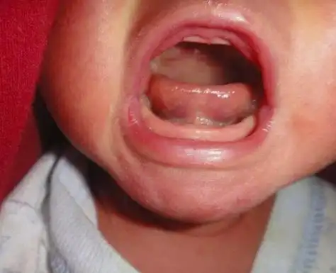 宝贝舌头发白宝妈如何清理宝宝舌头白怎么清理