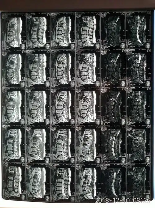 t11---l1椎体 压缩骨折 椎体成形术后两个月腰痛