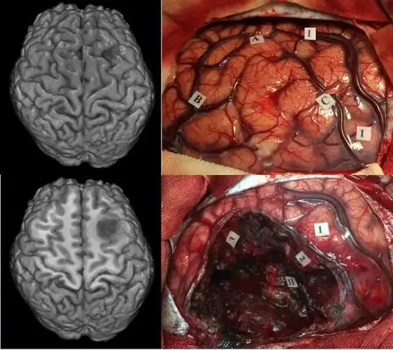 始终保持清晰的手术界面,特别是软脑膜与脑组织界面至关重要.