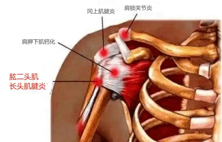 运动康复肩关节疼痛肱二头肌腱炎的康复方案