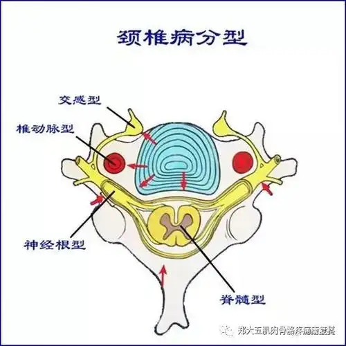 颈椎病养护小知识