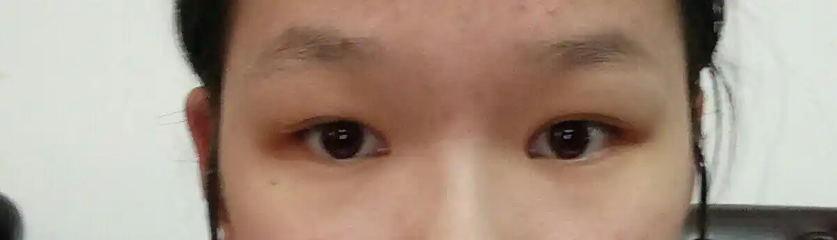 眼睛内陷不通过手术怎样改善?