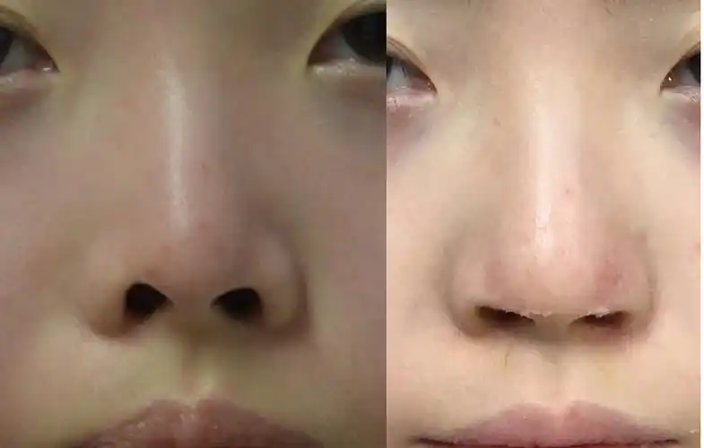 鼻孔外露是可以矫正的原创