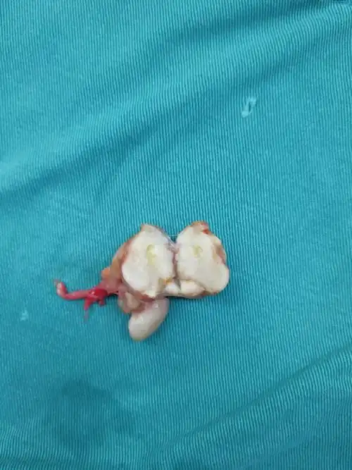 腱鞘巨细胞瘤 - 好大夫在线