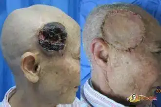 头皮肿瘤 - 好大夫在线