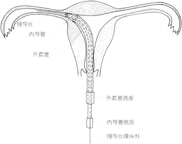 优点通过宫腔镜下输卵管插管通液术,不但能够借由宫腔镜观察子宫形态