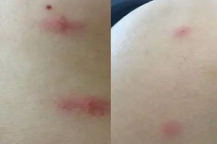 【图】螨虫叮咬后的症状图 注意卫生防患于未然