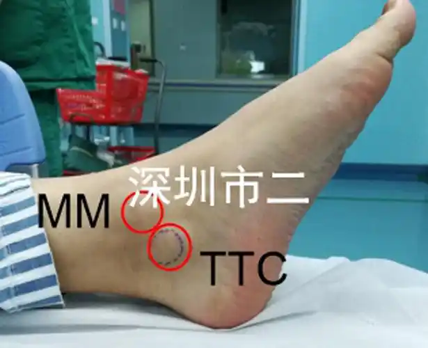 崴脚后疼痛之--跟距骨桥 - 好大夫在线