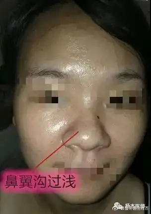 此沟不能少鼻翼沟成形在鼻头缩小中的重要作用