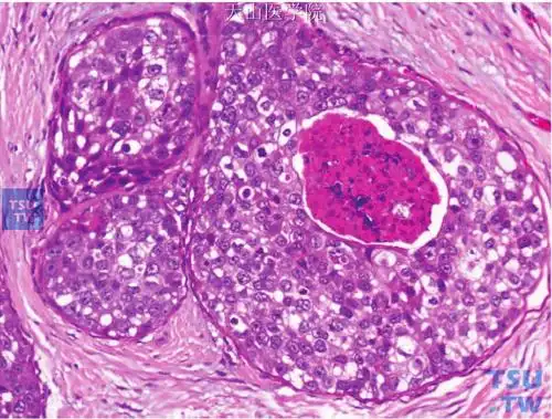 导管原位癌组织病理学特征及分类