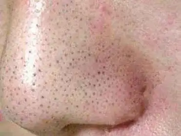 脸上的黑头能不能挤,应该如何祛除黑头