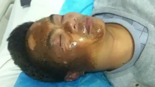 我13号被柴油火焰灼伤脸部,当时直接上医院,医生诊断为二度烧伤!