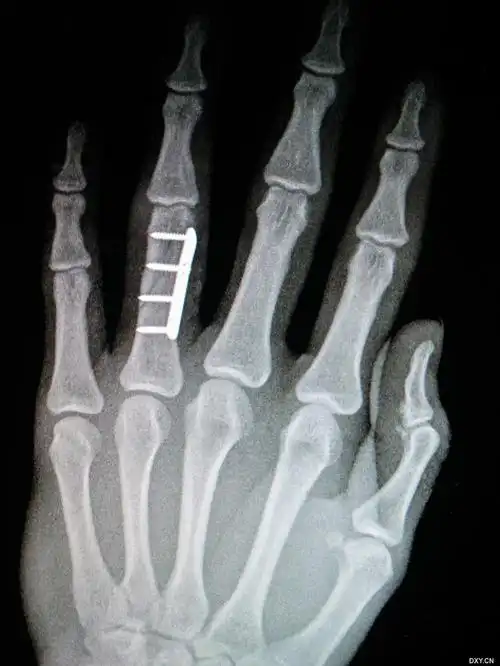 大家来找错:指骨骨折 - 病例中心 - 爱爱医医学网