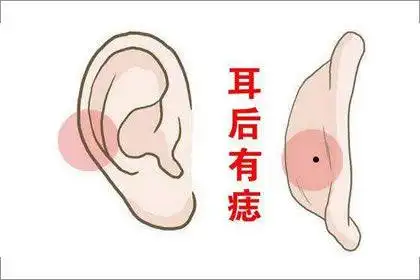 耳朵背后长痣代表着什么