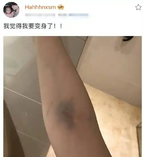 鞠婧祎晒膝盖受伤照,膝盖内侧多处淤青,透露自己打着多份工!