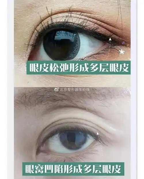 北京双眼皮科普多层眼皮如何变成好看的双眼皮