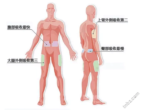 胰岛素注射部位没选对?小心低血糖!