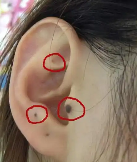 耳朵长痣的位置与命运 耳朵上各处痣的命运图 - 马克生活网