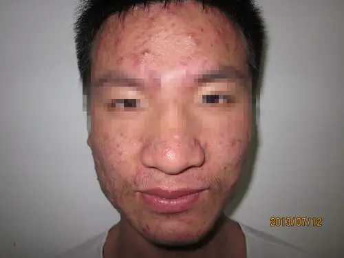 求治疗青春痘的去处.